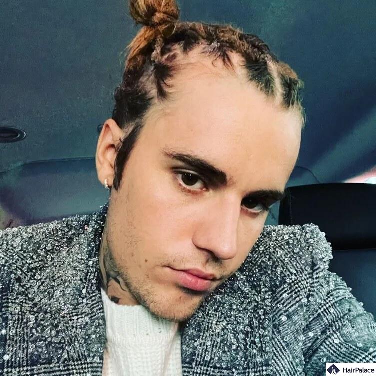 justin bieber traction alopecia